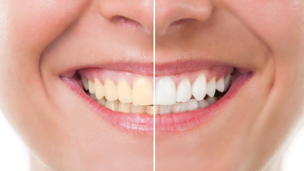 teeth_whitening